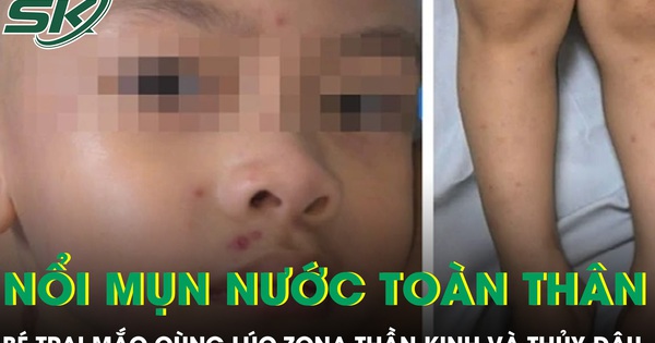 Bé trai 4 tuổi nổi kín mụn nước toàn thân sau khi mắc cùng lúc zona thần kinh và thủy đậu