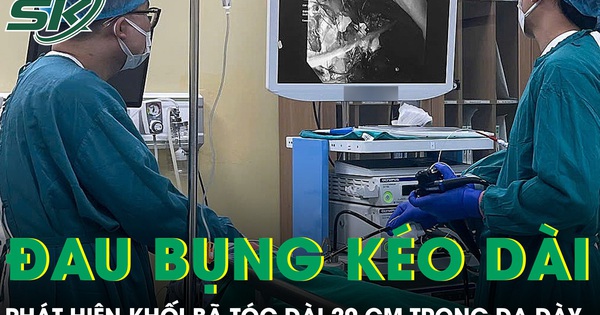 Bé gái 11 tuổi đau bụng kéo dài phát hiện khối bã tóc dài 20 cm trong dạ dày