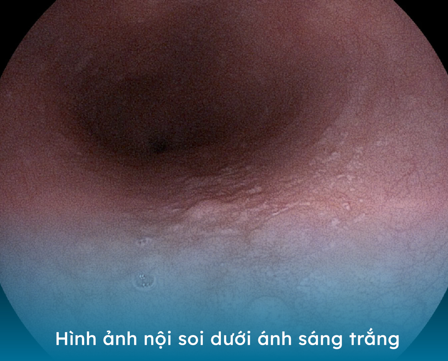 Bệnh viện Hoàn Mỹ Vinh: phát hiện nhiều trường hợp tiền ung thư thông qua nội soi- Ảnh 1.