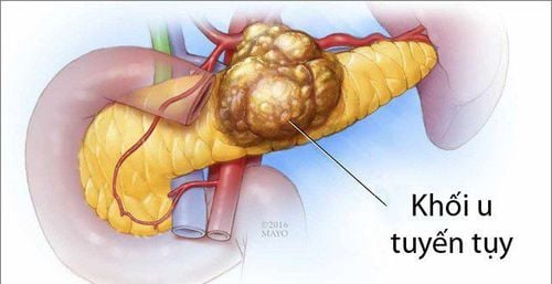6 dấu hiệu ung thư tụy, nhận biết sớm để điều trị kịp thời- Ảnh 1.