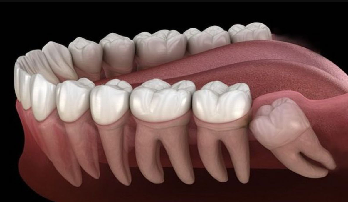 Những biến chứng thường gặp khi mọc răng khôn không thể xem nhẹ- Ảnh 2. Những biến chứng thường gặp khi mọc răng khôn không thể xem nhẹ- Ảnh 2.