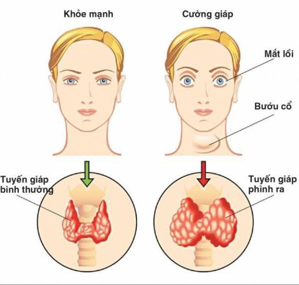 Những bệnh tuyến giáp ngày càng phổ biến trong cộng đồng- Ảnh 2. Những bệnh tuyến giáp ngày càng phổ biến trong cộng đồng- Ảnh 2.
