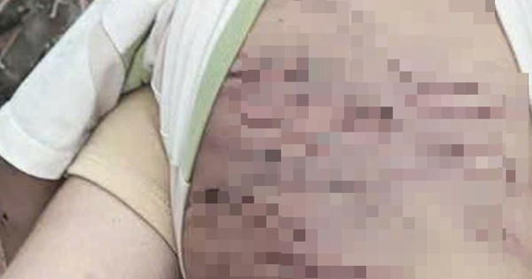 Bộ Y tế vào cuộc vụ bé trai 2 tuổi bị bạo hành dã man ở TP Hồ Chí Minh