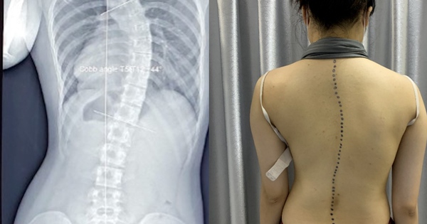 Vẹo cột sống ở trẻ gây hệ lụy gì?