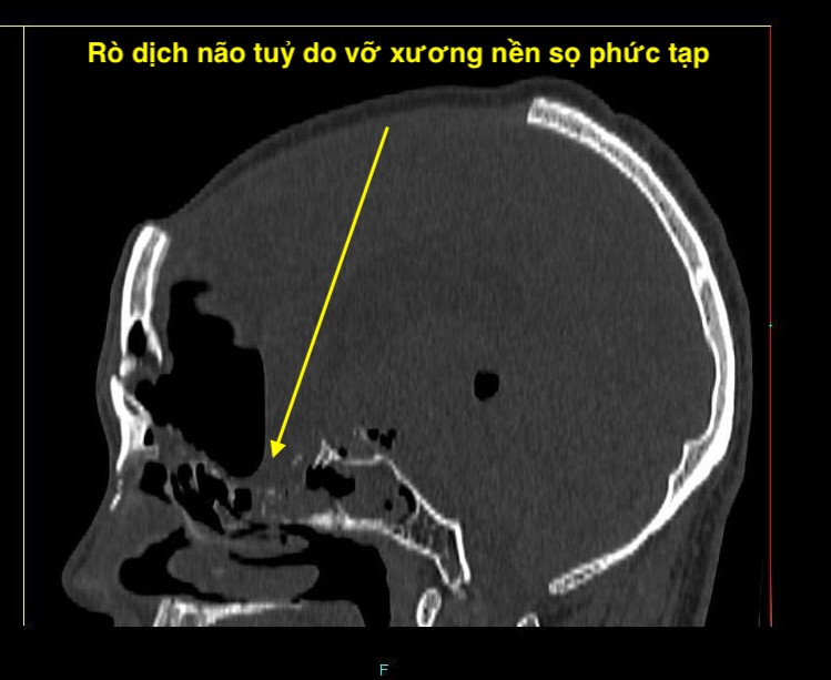 Vá rò dịch não tủy qua đường mũi, cứu 2 bệnh nhân trẻ- Ảnh 2.