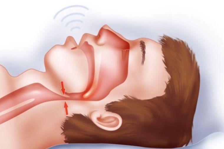 OSAS là một sự suy yếu của giấc ngủ và rối loạn hô hấp được định nghĩa như sự ngừng thở 10 giây, ít nhất 5 lần trong 1 giờ ngủ. OSAS là một sự suy yếu của giấc ngủ và rối loạn hô hấp được định nghĩa như sự ngừng thở 10 giây, ít nhất 5 lần trong 1 giờ ngủ.