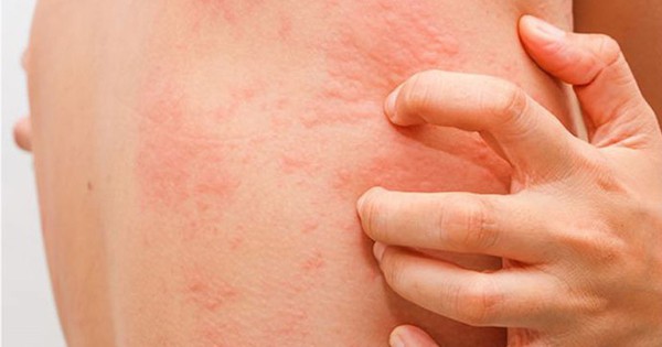 Da nổi mẩn đỏ, ngứa: dấu hiệu dị ứng hay cảnh báo bệnh lý tiềm ẩn?