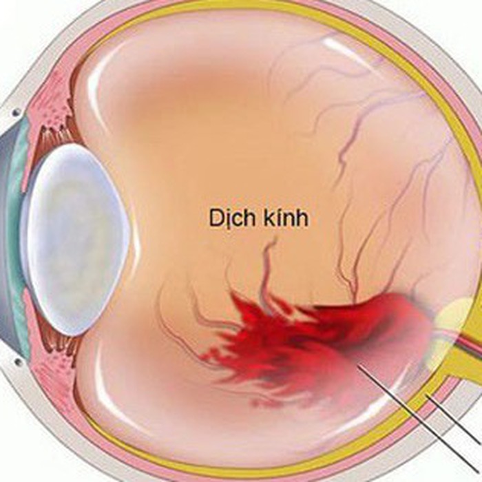 Ruồi bay trước mắt có thể là dấu hiệu xuất huyết dịch kính nguy hiểm- Ảnh 1.