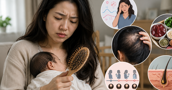 Rụng tóc sau sinh kéo dài: Khi nào không còn bình thường?