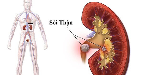 Nhập viện vì sỏi thận, chuyên gia khuyến cáo cần phát hiện sớm khi có biểu hiện này
