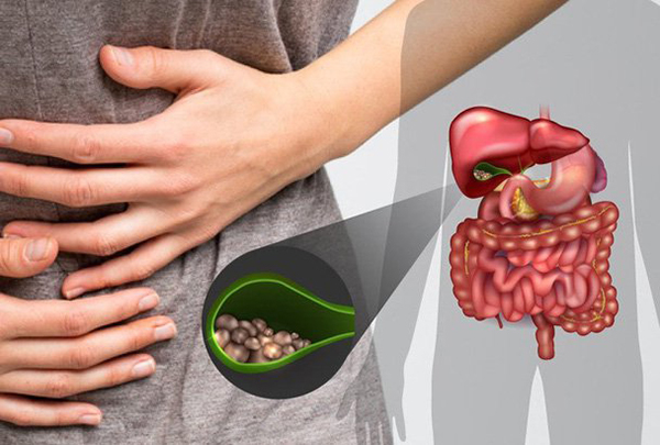 Bệnh sỏi túi mật phổ biến nhưng thường bị xem nhẹ, cảnh báo biến chứng nặng- Ảnh 1. Bệnh sỏi túi mật phổ biến nhưng thường bị xem nhẹ, cảnh báo biến chứng nặng- Ảnh 1.