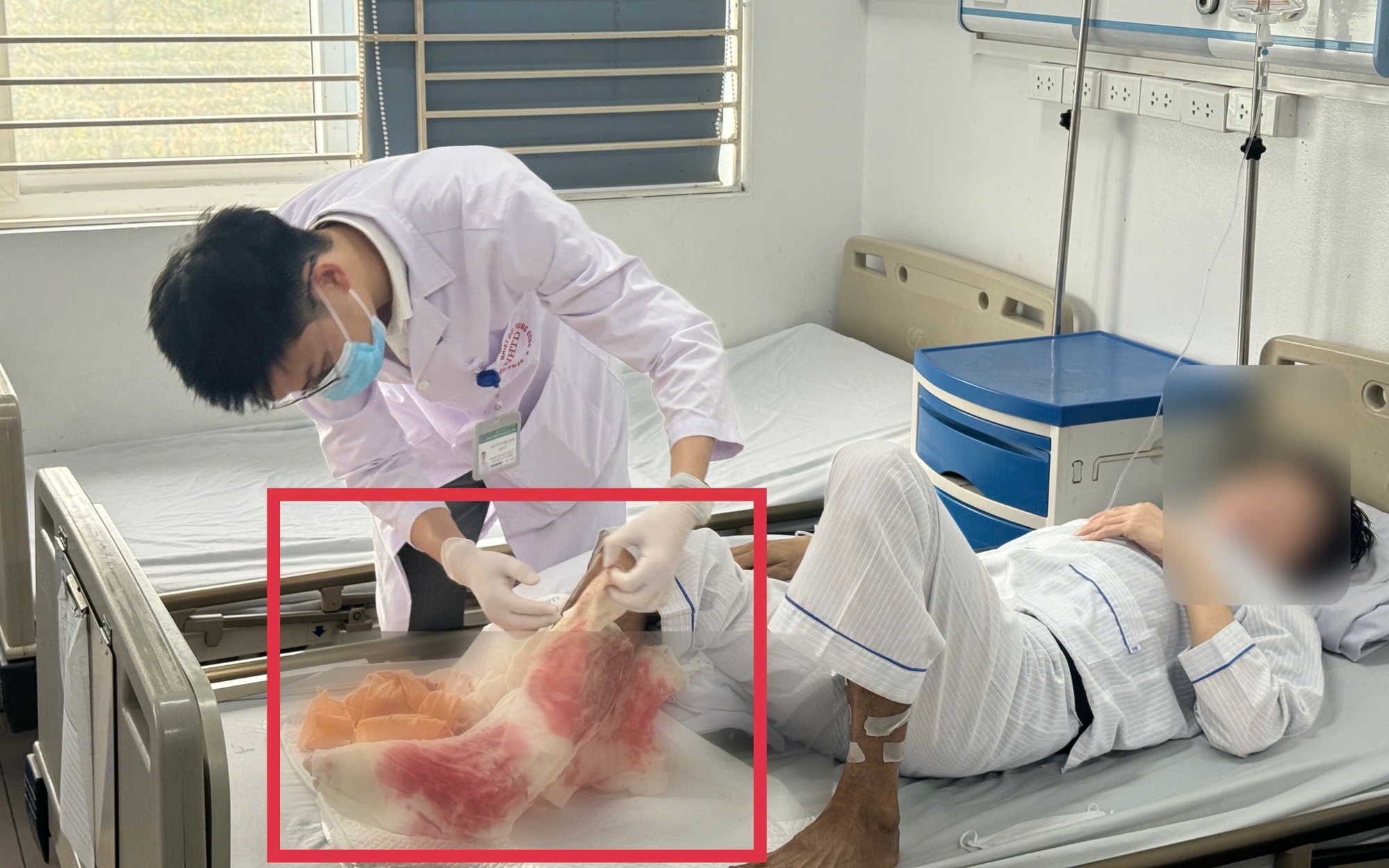 Suýt mất chân sau 1 tháng tự đắp lá chữa bỏng tại nhà