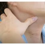Viêm tuyến giáp mạn tính có làm tăng nguy cơ ung thư tuyến giáp không ?