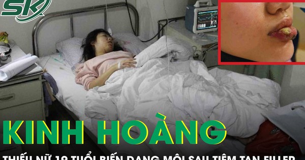 Thiếu nữ 18 tuổi biến dạng môi sau tiêm tan filler tại cơ sở thẩm mỹ chui
