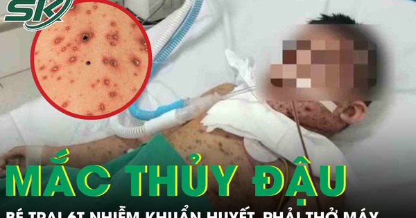 Biến chứng thủy đậu, bé trai 6 tuổi nhiễm khuẩn huyết, phải thở máy nguy kịch