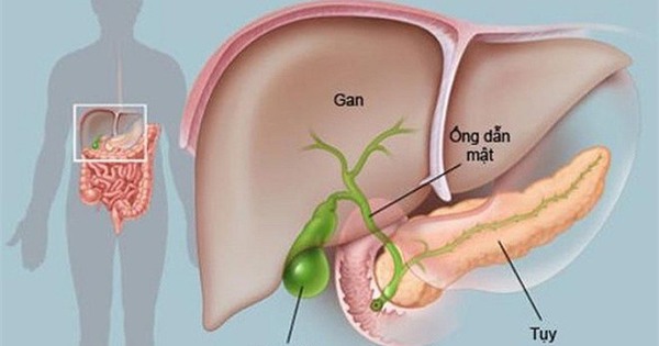 6 dấu hiệu ung thư tụy, nhận biết sớm để điều trị kịp thời