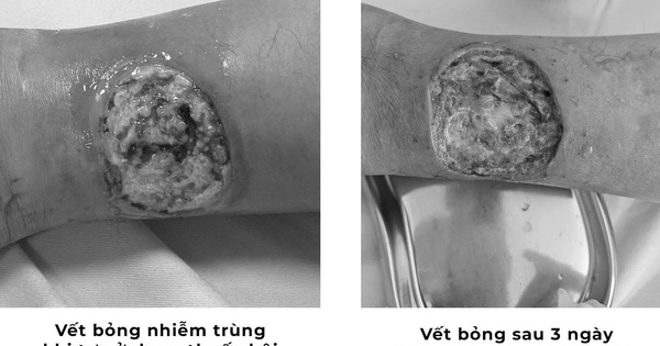 Tự chữa bỏng bằng thuốc dân gian, người đàn ông suýt hoại tử chân