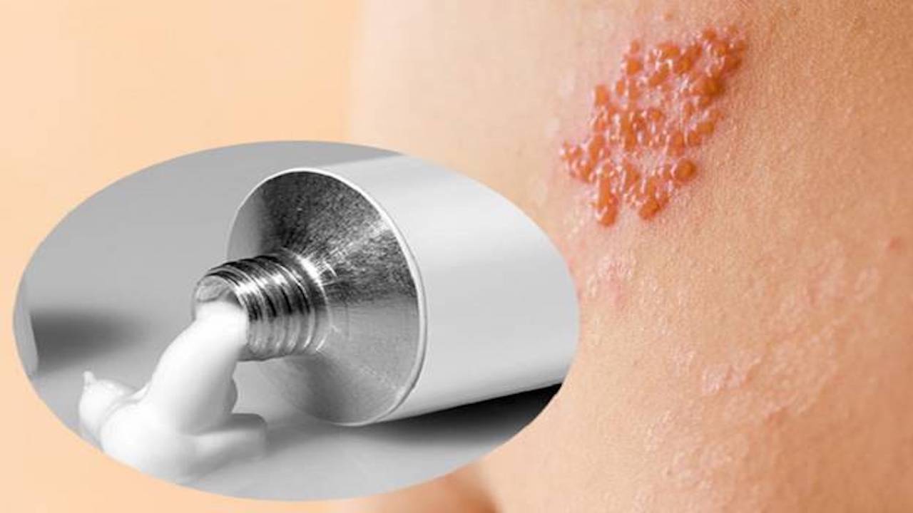 Zona là bệnh có thể kiểm soát tốt nếu được phát hiện sớm và chăm sóc đúng cách. Zona là bệnh có thể kiểm soát tốt nếu được phát hiện sớm và chăm sóc đúng cách.