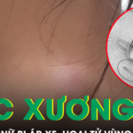 Xương cá nằm trong họng 5 tháng gây áp xe hoại tử vùng cổ