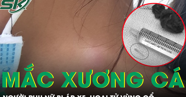 Xương cá nằm trong họng 5 tháng gây áp xe hoại tử vùng cổ