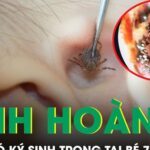 Kinh hoàng phát hiện ổ ve chó ký sinh trong tai bé trai 7 tuổi