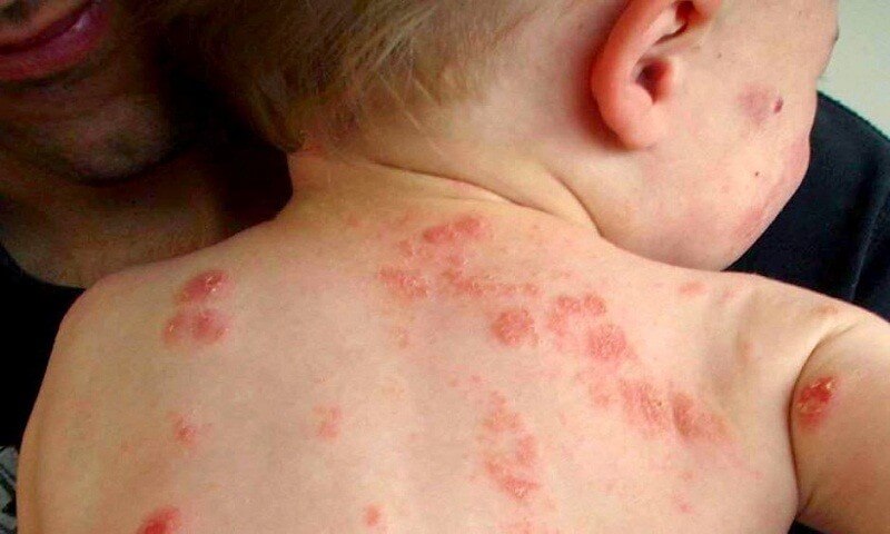 Bệnh chốc mùa hè: Nhận biết sớm để tránh biến chứng- Ảnh 2.