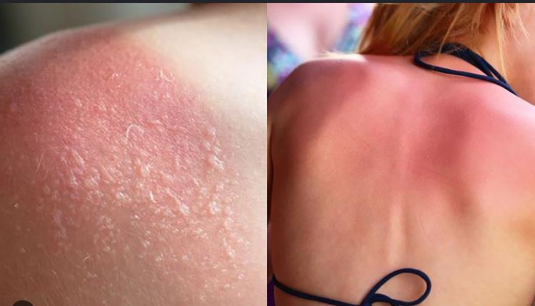 Bỏng nắng phải làm gì để tránh tổn thương da nghiêm trọng?- Ảnh 1.