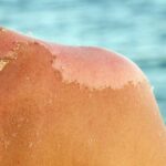 Bỏng nắng phải làm gì để tránh tổn thương da nghiêm trọng?