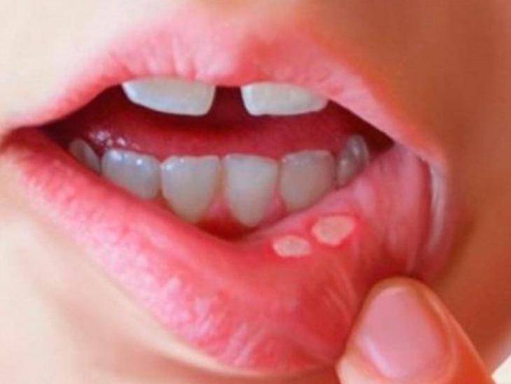 Phân biệt nhiệt miệng và ung thư lưỡi: Cách nhận biết sớm căn bệnh nguy hiểm- Ảnh 1. Phân biệt nhiệt miệng và ung thư lưỡi: Cách nhận biết sớm căn bệnh nguy hiểm- Ảnh 1.