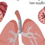 Khi nào người bệnh hen cần đến viện ngay lập tức?