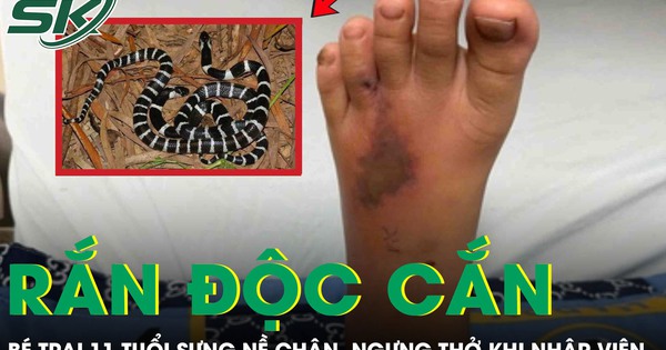Bé trai 11 tuổi bị rắn độc cắn, sưng nề chân, ngưng thở khi nhập viện