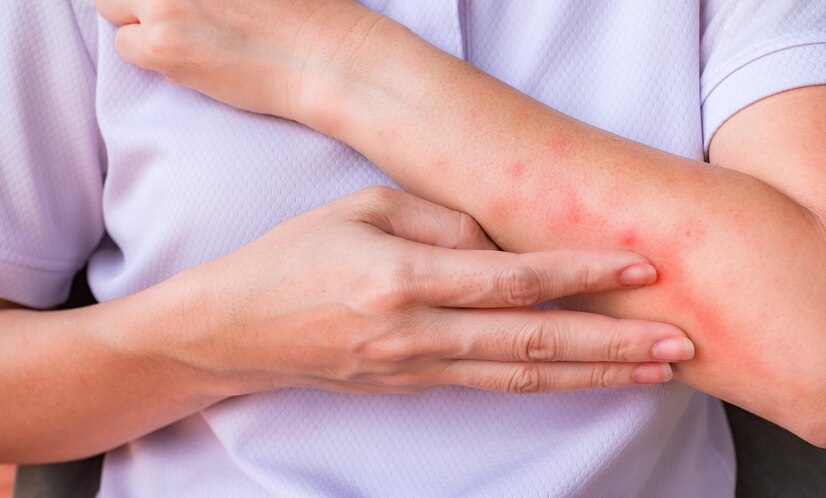 Nắng nóng khiến nguy cơ viêm da gia tăng, phòng ngừa thế nào?- Ảnh 2. Nắng nóng khiến nguy cơ viêm da gia tăng, phòng ngừa thế nào?- Ảnh 2.
