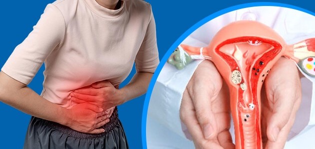 7 dấu hiệu thường gặp của lạc nội mạc tử cung chị em nên chú ý- Ảnh 1.