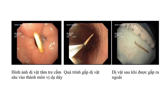 Nuốt nhầm tăm tre, người đàn ông suýt phải phẫu thuật vì áp xe gan- Ảnh 3.